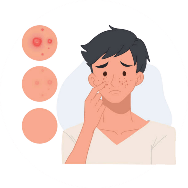 Acne Solutions in Pakistan at SkinStash