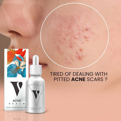 Acne Serum - Vcare Natural
