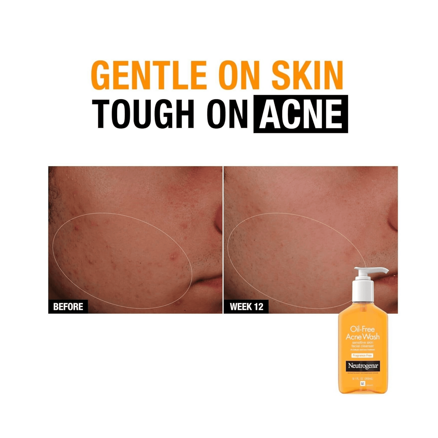 Neutrogena oil-free acne wash advertisement showing before and after effects on skin.