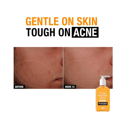 Neutrogena oil-free acne wash advertisement showing before and after effects on skin.