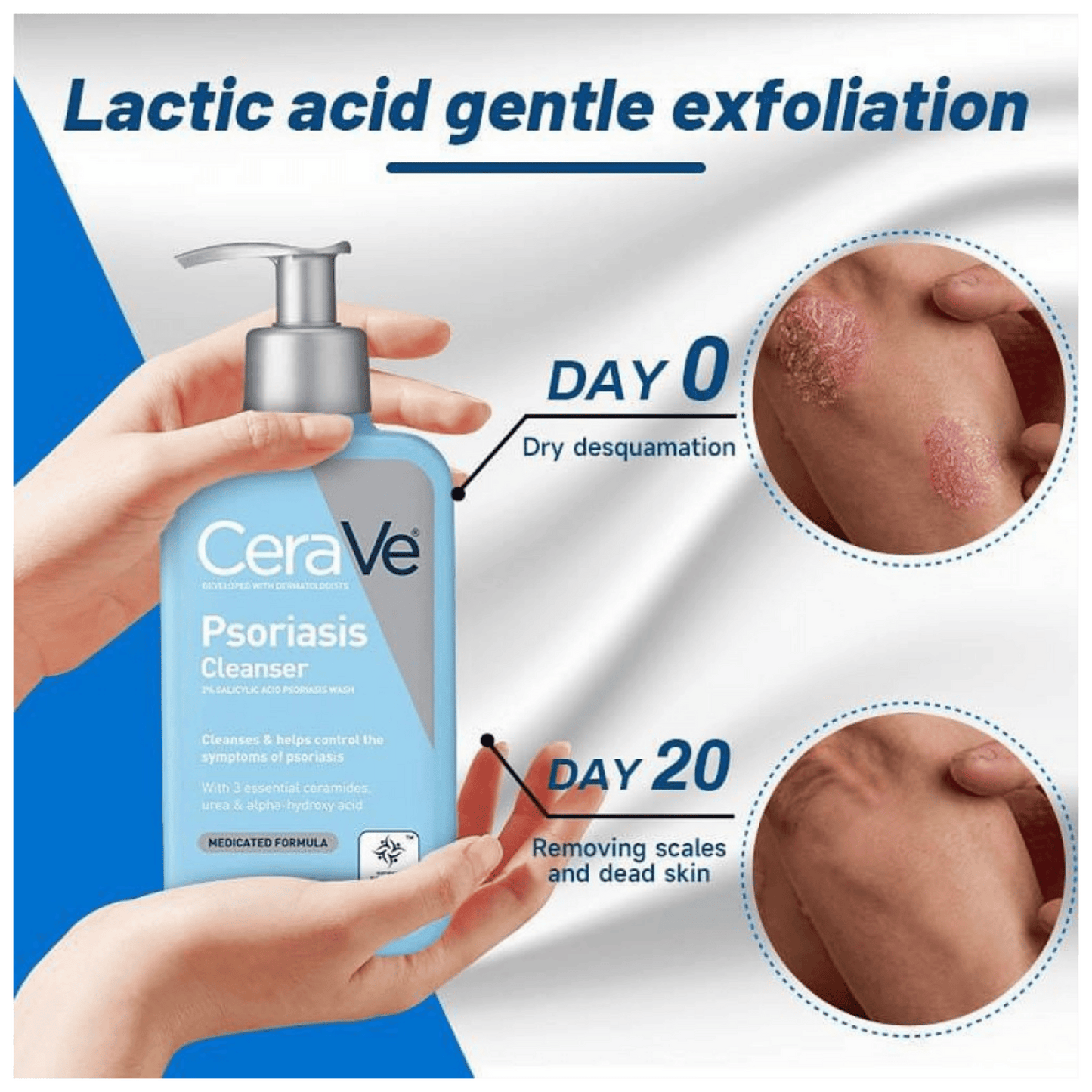 CeraVe Psoriasis Cleanser with 2% Salicylic Acid Psoriasis Wash (237ml)